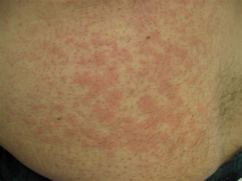 Dust Mite Allergy Symptoms Rash Urticaria Cures