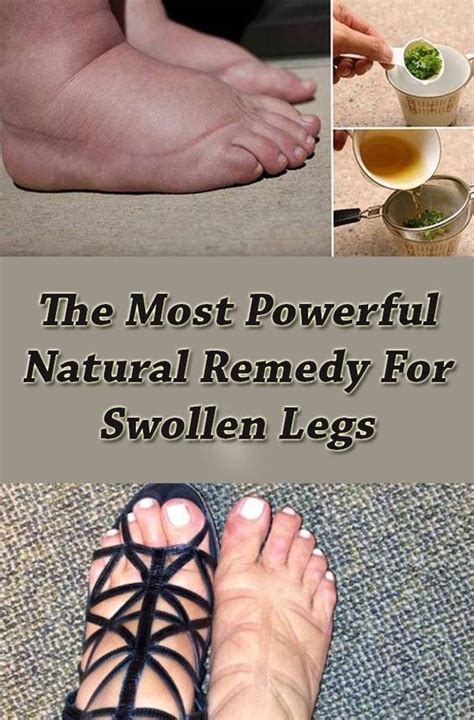 Powerful Natural Remedy For Swollen Legs Top 5 Diy Swollen Legs Swollen Feet Remedy Foot