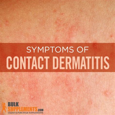 Contact Dermatitis Symptoms Causes And Treatment