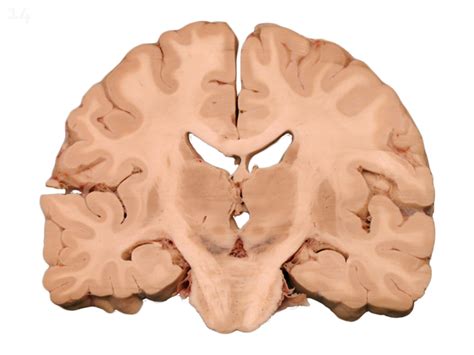 Coronal Brain Section Labels Diagram Quizlet