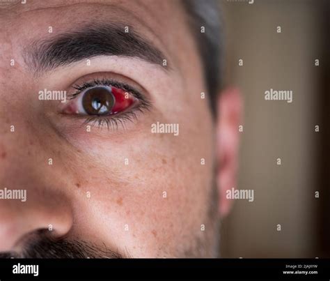Subconjunctival Hemorrhage On Man Eye Bloody Eye Broken Blood Vessel