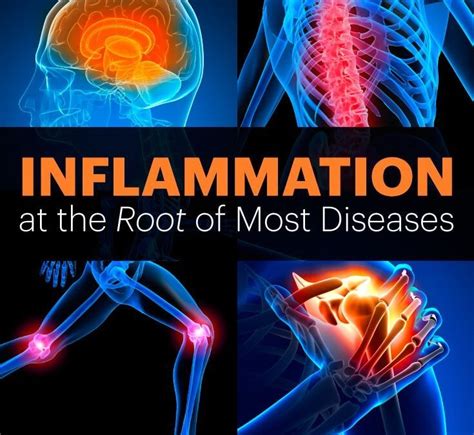Resolving Inflammation All Degrees Of Health