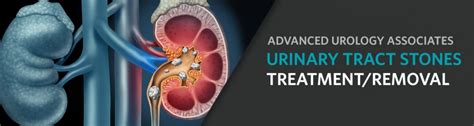 Urinary Tract Stones Calculi Treatmentremoval Advanced Urology