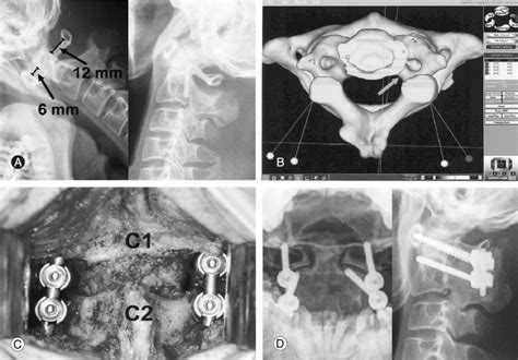 A Case Of C1 2 Fixation Using C1 Lateral Mass Screws And C2