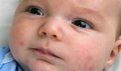 Baby Acne A Brief Overview At Home Acne Remedy