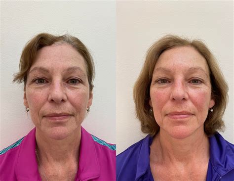 New Cosmetic Acupuncture Before And After Photos