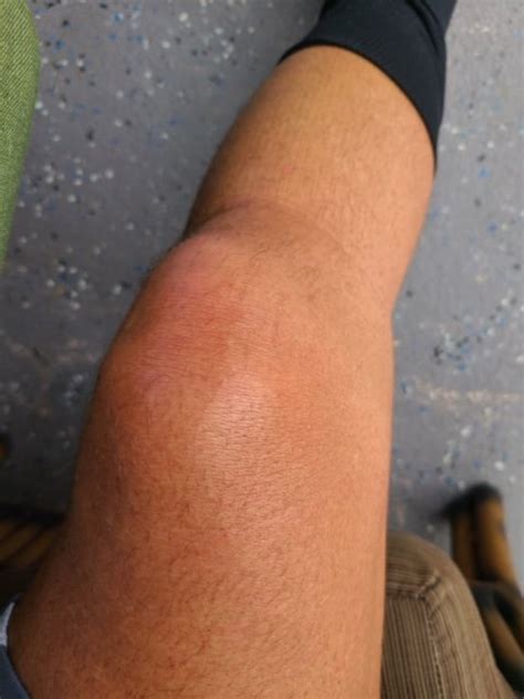 What Does It Mean If My Knee Is Swollen