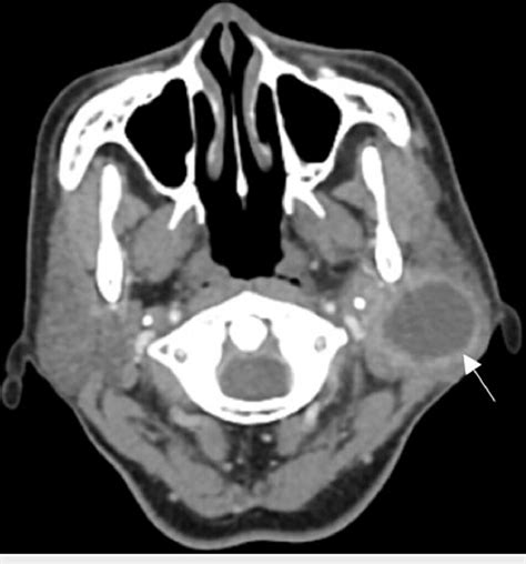 Axial Cect Revealed A Homogenous Lesion In The Left Parotid Gland With