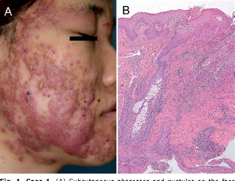Figure 1 From Two Cases Of Acute Febrile Neutrophilic Dermatosis