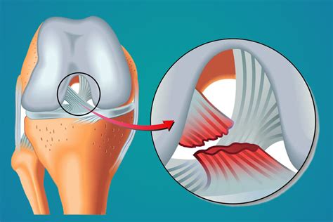 Lesiones De Rodilla Lesiones Del Ligamento Cruzado Anterior De La