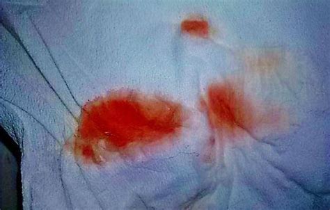 Pin Di Implantation Bleeding