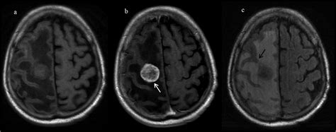 Solitary Cerebral Metastases Vs High Grade Gliomas Usefulness Of Two