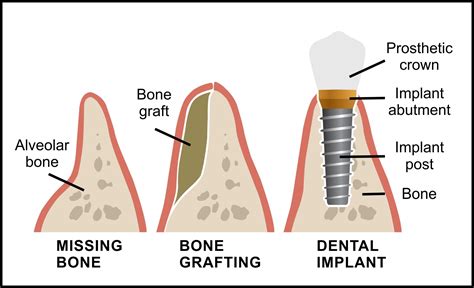 Bone Grafting For Dental Implants Sherway Gardens Dental Centre
