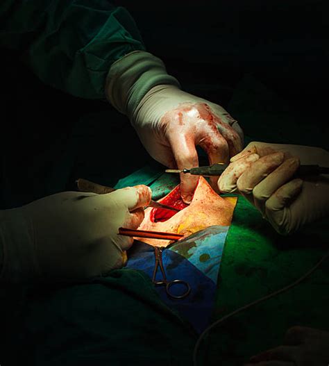 Surgeons perform hernia mesh surgery by using surgical mesh made from plastic or biologic materials to hold in protruding tissue or organs. Hernia Mesh Stock Photos, Pictures & Royalty-Free Images - iStock