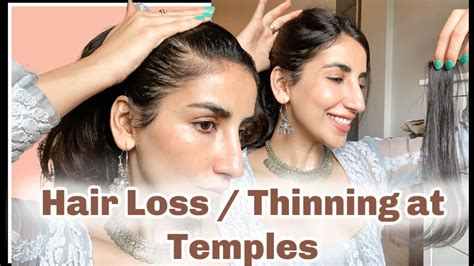 Update More Than Hair Thinning At Temples Female Super Hot In