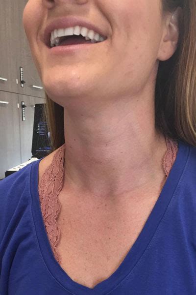 Scar Photos Thyroid Cancer Surgery Thyroidectomy Endocrine Surgery