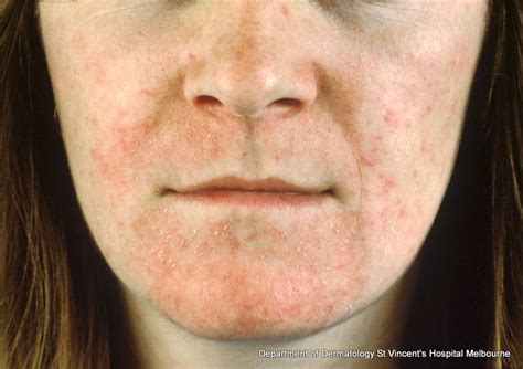Acd A Z Of Skin Perioral Dermatitis