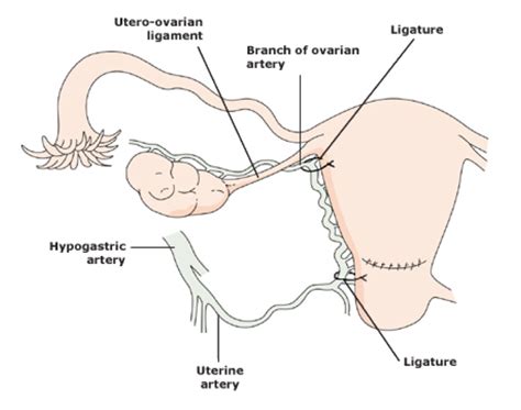 Uterine Incision Extensions Rural Surgery Obstetrics