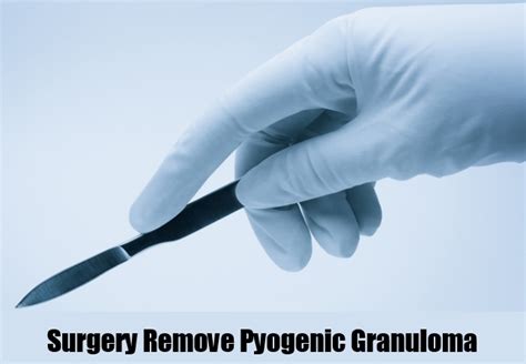 6 Ways To Treat Pyogenic Granuloma Natural Home Remedies And Supplements