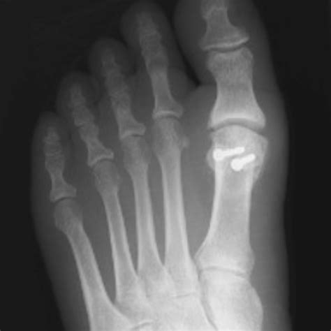 Hallux Limitus Arthritis Of The Big Toe Thames Foot Clinic