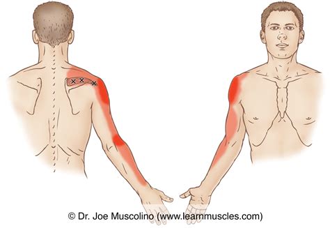 Supraspinatus Trigger Points Learn Muscles