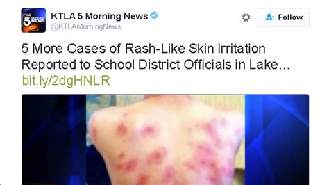 Students At California School Develop Mysterious Rash Fox News