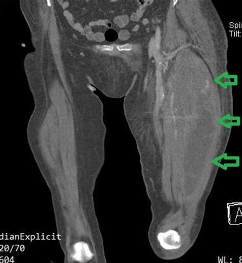 Cureus Late Onset Hematoma Due To Bleeding Of A Small Branch Of The