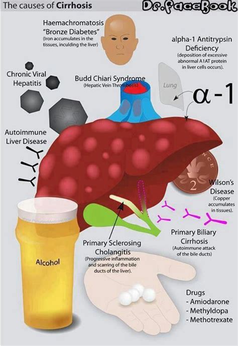 The progression of liver injury to cirrhosis may occur over weeks to years. Cirrhosis on the liver | Nursing *tid bits* | Pinterest ...