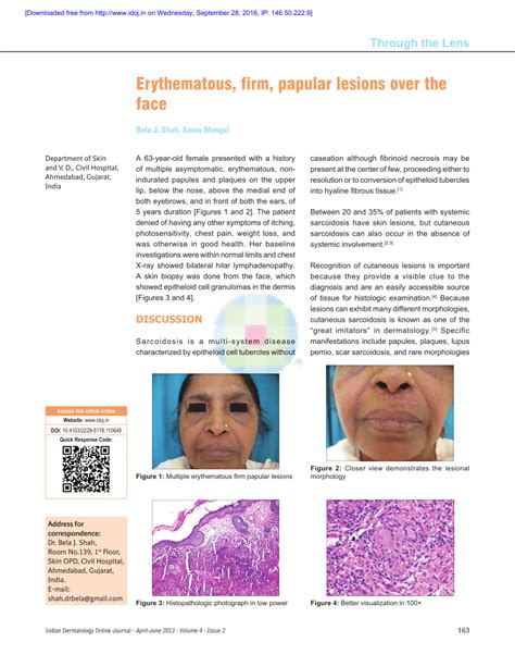 Pdf Erythematous Firm Papular Lesions Over The Face