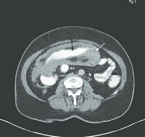 Ct Scan Large Bowel Intussusception White Arrow Showing The Lead Point
