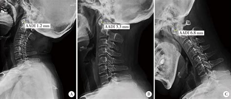 Analysis Of Cervical Instability And Clinical Characteristics In