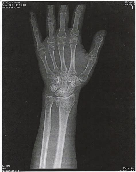 Wrist X Ray A Photo On Flickriver