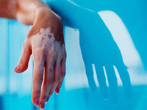 Molluscum Contagiosum A Common Viral Skin Condition In Children Texas S