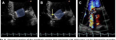 Figure 9 From Mitral Prosthetic Valve Assessment By Echocardiographic