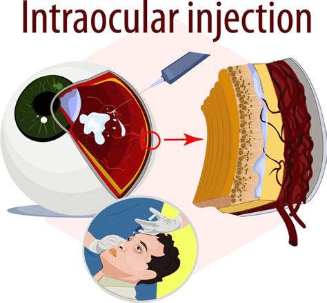 Eye Damage From Repeated Intravitreal Injections Macular