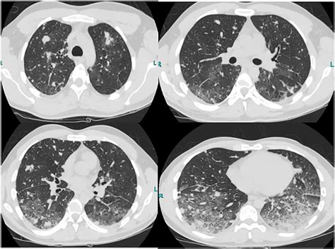 Eosinophilic Lung Disease As A Sequela Of Mssa Pneumonia Bmj Case Reports