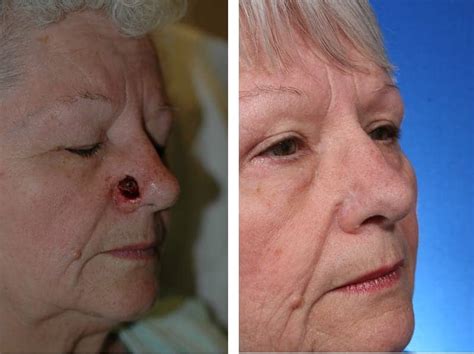 New Procedure Can Repair Skin Cancer On The Nose In One Step Plastic