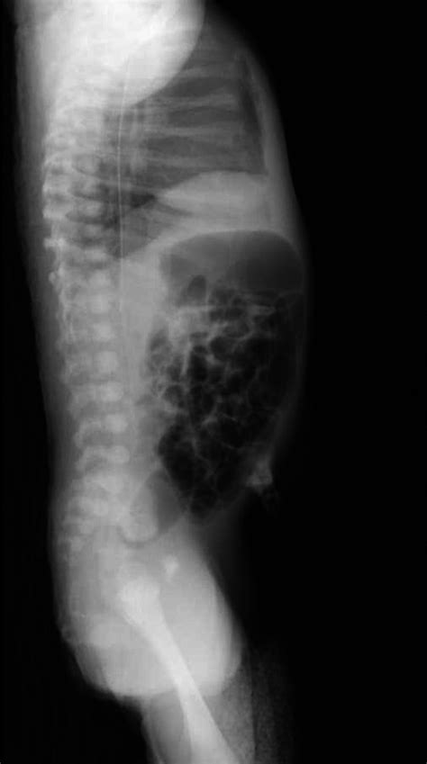 Orogastric Tube Ogt Directed Posteriorly Instead Of Anteriorly