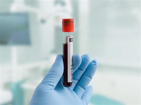 Blood Test To Distinguish Benign Versus Cancerous Nf1 Tumors Nci