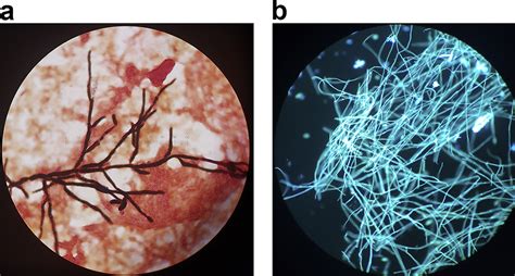 Disseminated Fusarium Solani Complex Infection Clinical Microbiology