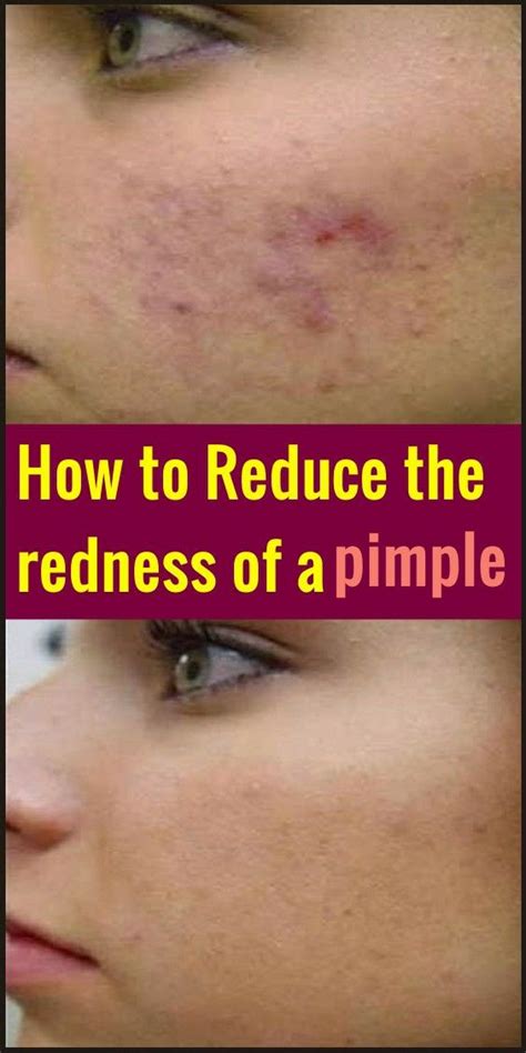 How To Reduce The Redness Of A Pimple In 2021 Pimples How To Reduce