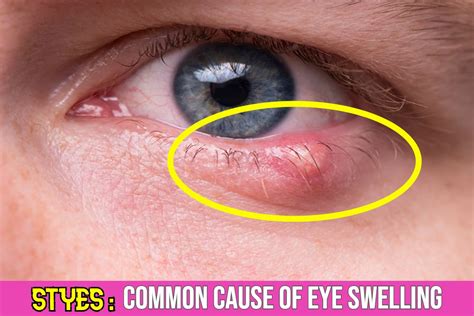 Do Styes Cause Eyelid Swelling Symptoms Treatment