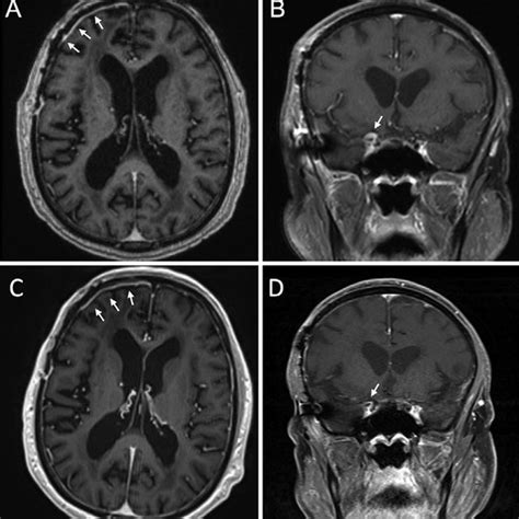 T1 Weighted Post Gadolinium Mri Scans Of The Brain In Axial A And