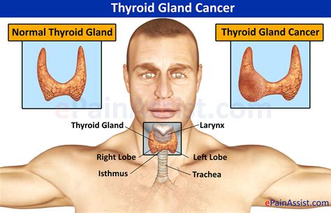 Thyroid Gland Cancercausessymptomstreatment Surgery Harmone Chemo