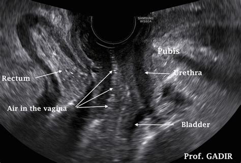 above 3 images show longitudinal view of a normal looking tubular cervix longitudinal v