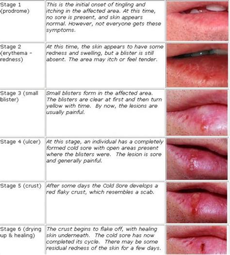 Cold Sore On Lip Stages