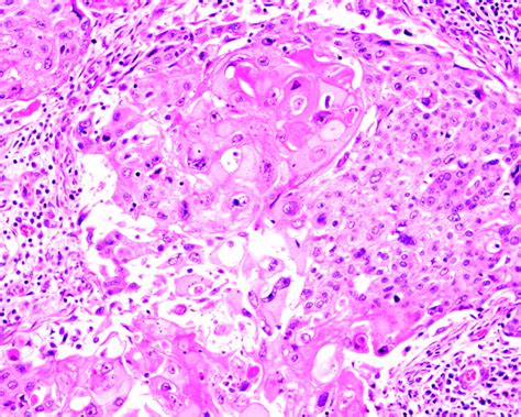 Metaplastic Carcinoma Of The Breast A Clinicopathological Review