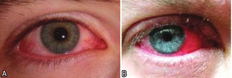An Image Of An Eye With A Mild Redness And B An Eye With Severe