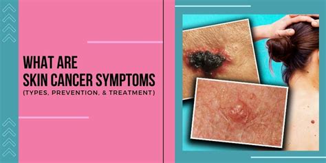 What Are Skin Cancer Symptoms Types Prevention And Treatment University Cancer Centers
