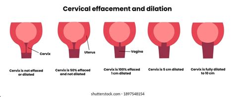 Cervix Dilation Chart Labor